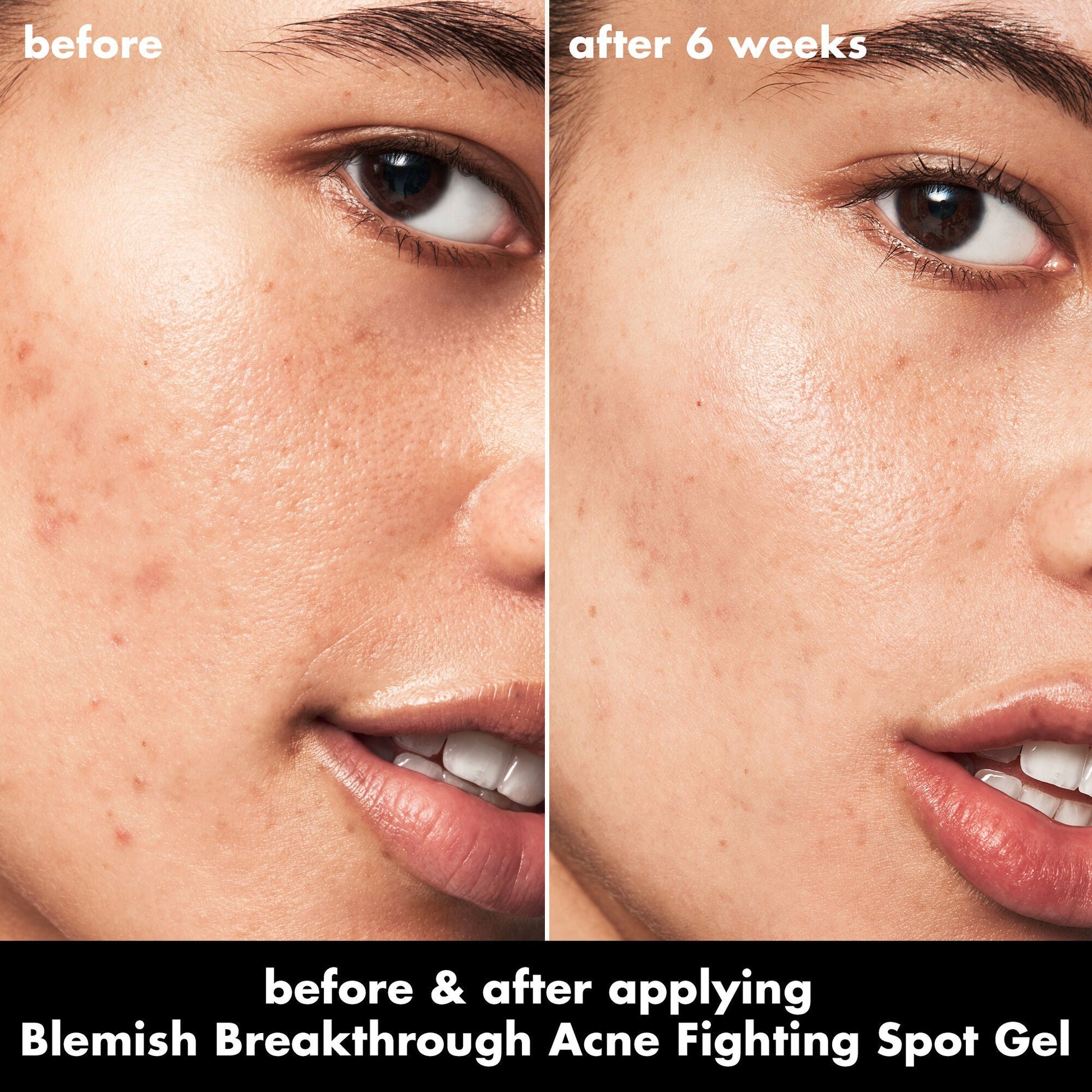 blemish-breakthrough-acne-fighting-spot-gel-d1 0326_EDU_BB_SpotGel_BA_ISABELLA.jpg