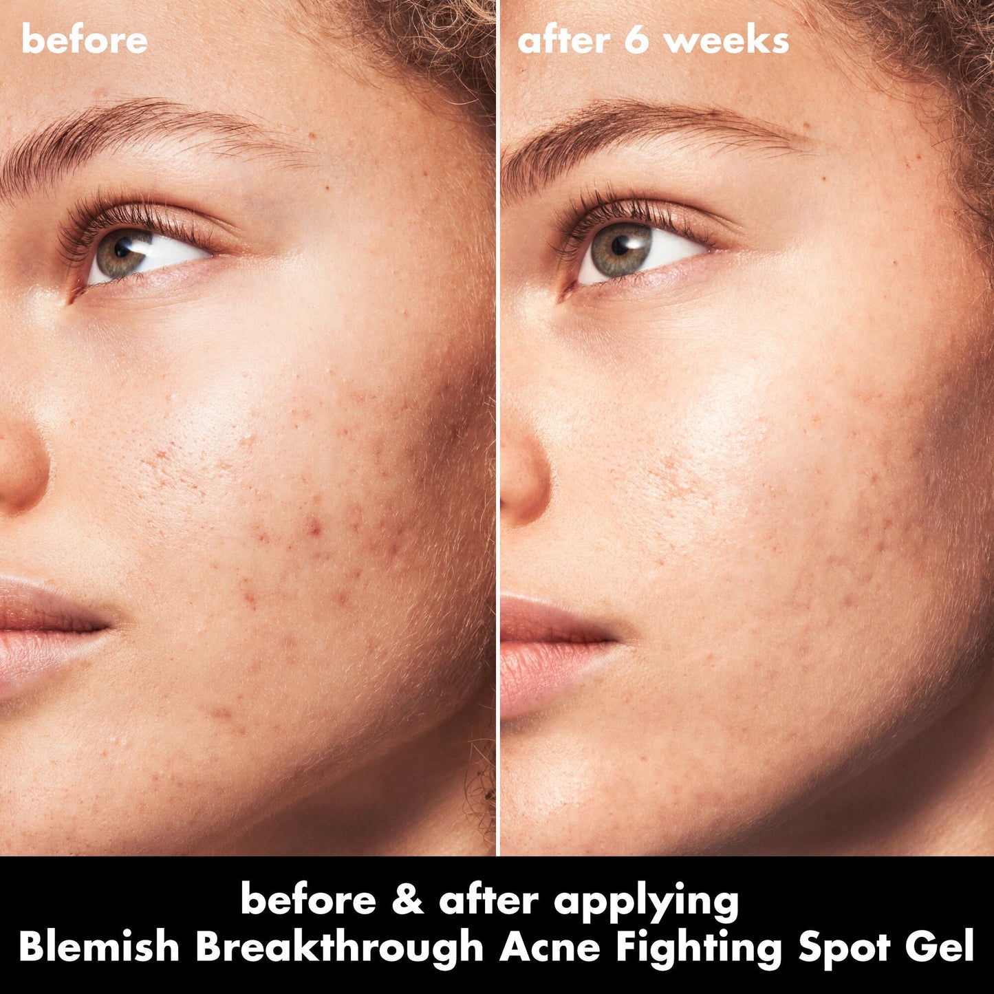 blemish-breakthrough-acne-fighting-spot-gel-d1 0326_EDU_BB_SpotGel_BA_MARLEY.jpg