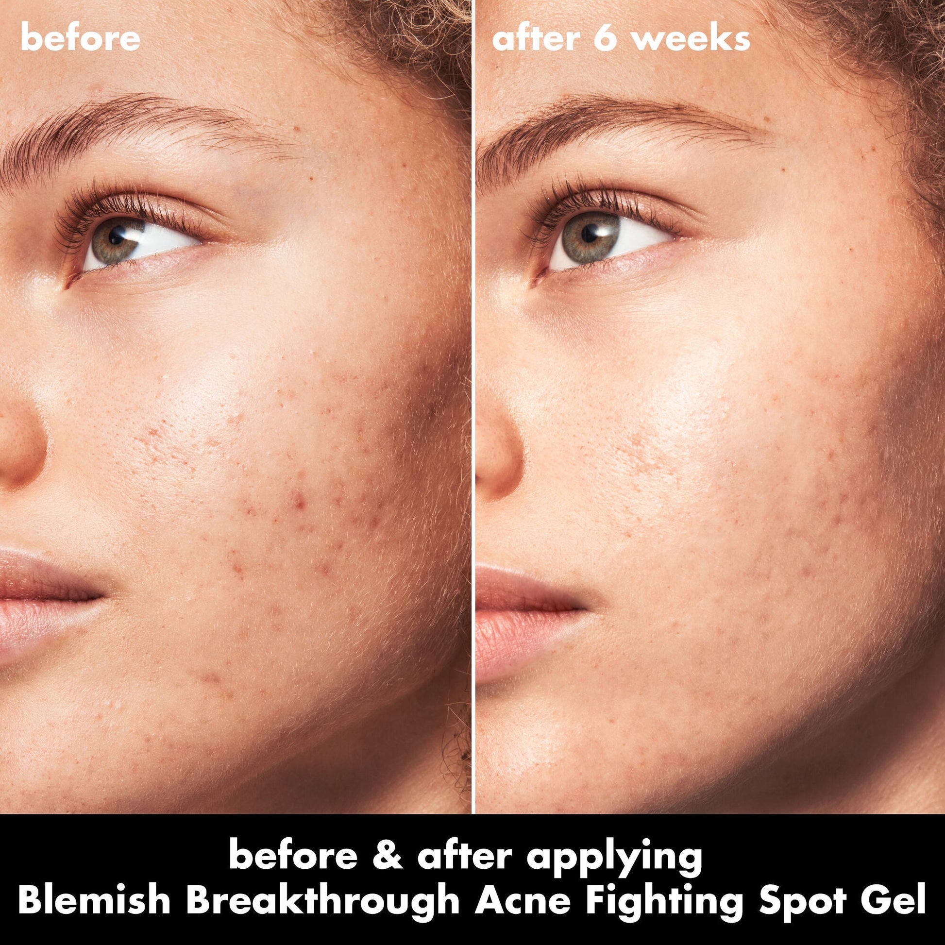 blemish-breakthrough-acne-fighting-spot-gel-d1 0326_EDU_BB_SpotGel_BA_MARLEY.jpg