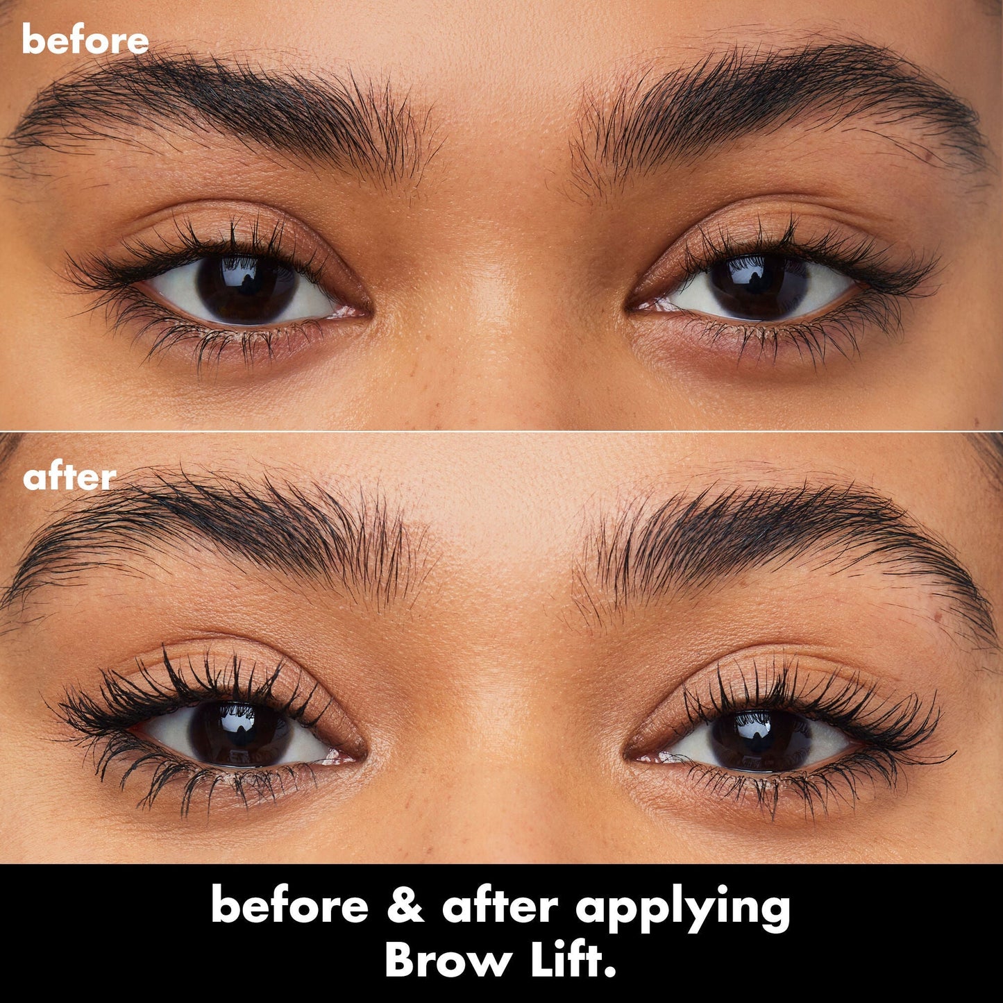 brow-lift-k2 0326_EDU_BrowLift_BA.jpg
