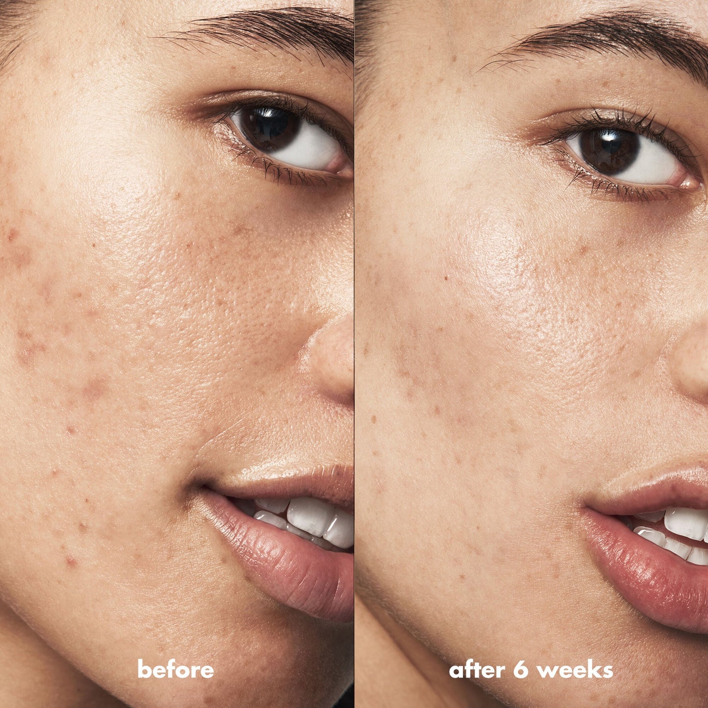 blemish-breakthrough-acne-calming-water-cream-mini-x8 Acne_PDP_Isabella_Before_After_f0d452cd-72f5-4bb8-a6df-0b3cc23143ef.jpg
