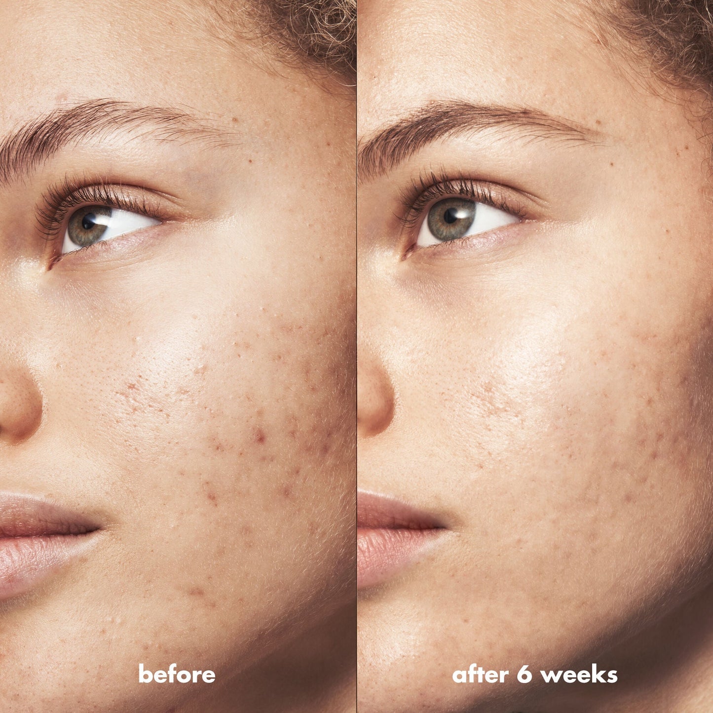 blemish-breakthrough-acne-clarifying-cleanser-z9 Acne_PDP_Marley_Before_After_216490cc-567c-424e-91eb-5374368f15d6.jpg
